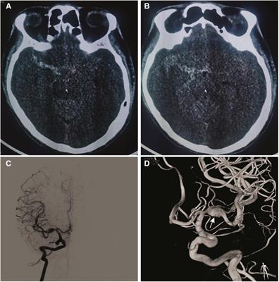 Case Report: Tubridge flow diverter for a ruptured fusiform aneurysm of the M1 segments of the middle cerebral artery